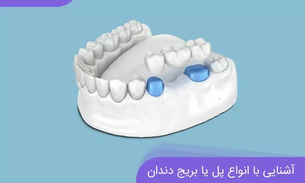 بریج دندان