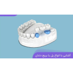 بریج دندان