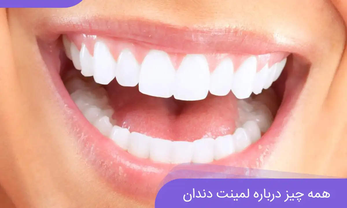 لمینت دندان ارزان
