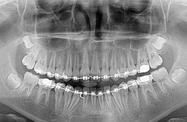رادیوگرافی بایت وینگ