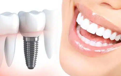 dental-implant