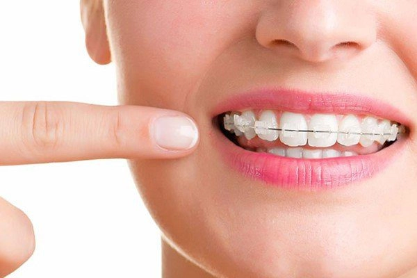 ارتودنسی دندان ارزان