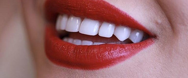 ترمیم دندان با کامپوزیت و لمینت دکتر نسرین سیاه تیری